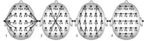 Монтажные схемы для регистрации электроэнцефалограммы: 1 - монополярное отведение с ушным референтным электродом; 2 - монополярное вертексное отведение; 3 - биполярное продольное отведение; 4 - биполярное поперечное отведение