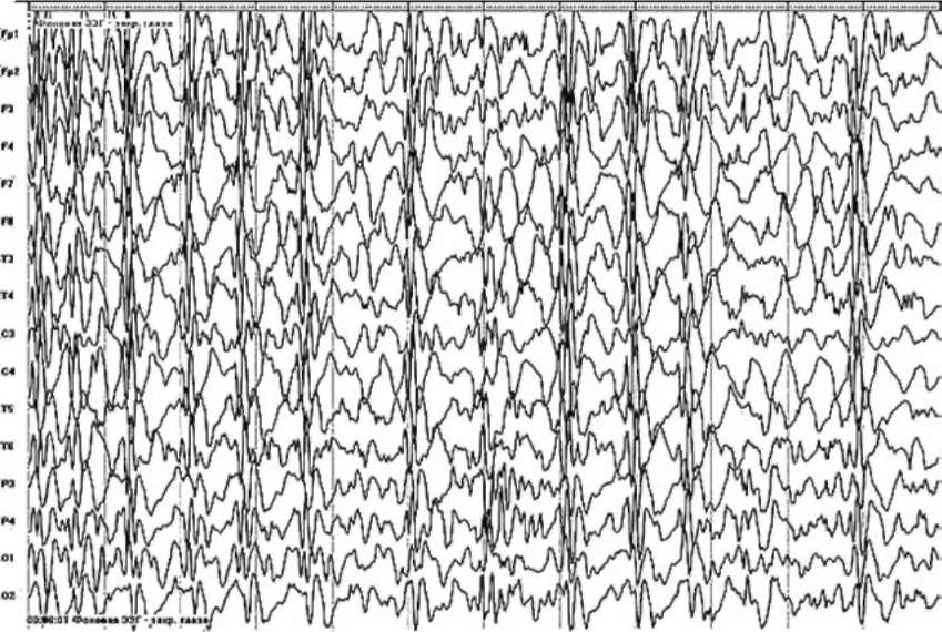 Синдром Леннокса-Гасто. На электроэнцефалограмме медленные комплексы пик-волна 1,5-2,5 Гц (Родригес В.Л., 2004)