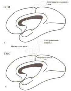 Глубинная стимуляция мозга (ГСМ) и транскраниальная магнитная стимуляция (ТМС)