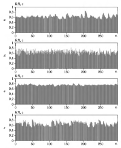 Примеры ритмограмы при различных вилах сердечного ритма