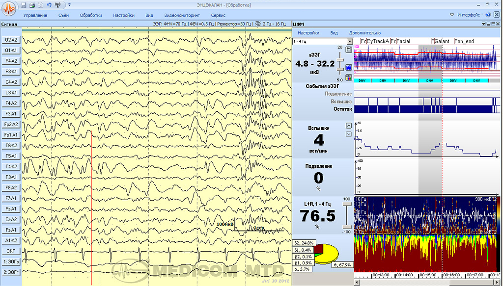 Многоканальный ЭЭГ-мониторинг церебральных функций