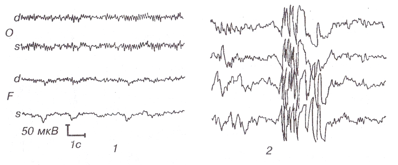 Спайки на ээг. Генерализованная Спайк волна на ЭЭГ. Генерализованные разряды на ЭЭГ. Генерализованные Спайк волновые разряды на ЭЭГ. Вспышка Спайк медленная волна на ЭЭГ.