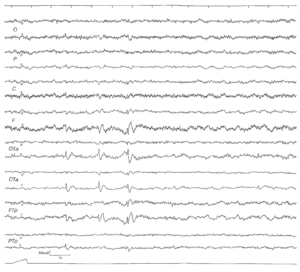 Межприступная ЭЭГ (3 мин. гипервентиляции) больного 37 лет с височнодолевой эпилепсией с редкими амигдало-гиппокампальными припадками