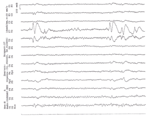 ЭЭГ пациента 27 лет с резистентными комплексными парциальными припадками с автоматизмами с эпилептогенным фокусом в левой височной доле