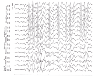 ЭЭГ пациента с рис. 70 после наращивания дозы карбамазепина до 20 мг/кг без уменьшения прежних припадков, но с присоединением коротких «атипичных абсансов» и атонических припадков