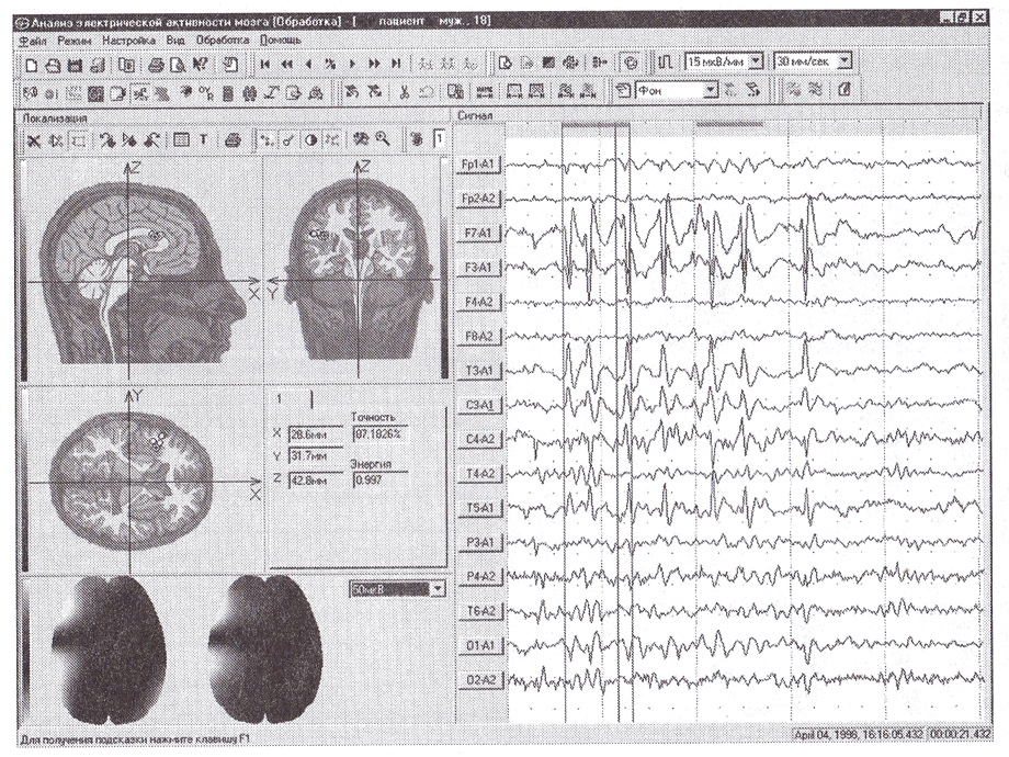 Пароксизмальная активность мозга. Атлас ЭЭГ Мухин. ЭЭГ картирование коры. Умственная отсталость на ЭЭГ. Энцефалан-131-03 программное обеспечение.