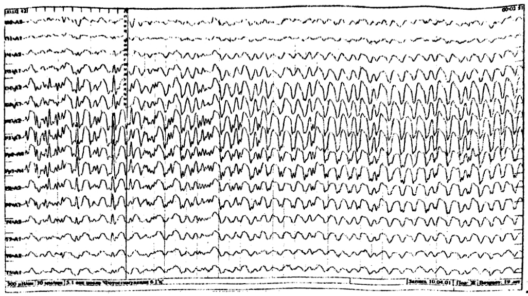 Ээг показывает эпилепсию. Генерализованная эпилепсия ЭЭГ. Абсансная эпилепсия на ЭЭГ. ЭЭГ при эпилепсии. Генерализованная эпилептиформная активность на ЭЭГ.