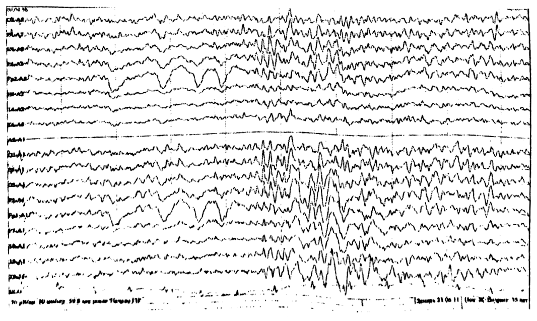 Ээг показывает эпилепсию. Височная эпилепсия на ЭЭГ. ЭЭГ при височной эпилепсии. Заключение ЭЭГ при эпилепсии. Парциальная моторная эпилепсия ЭЭГ.