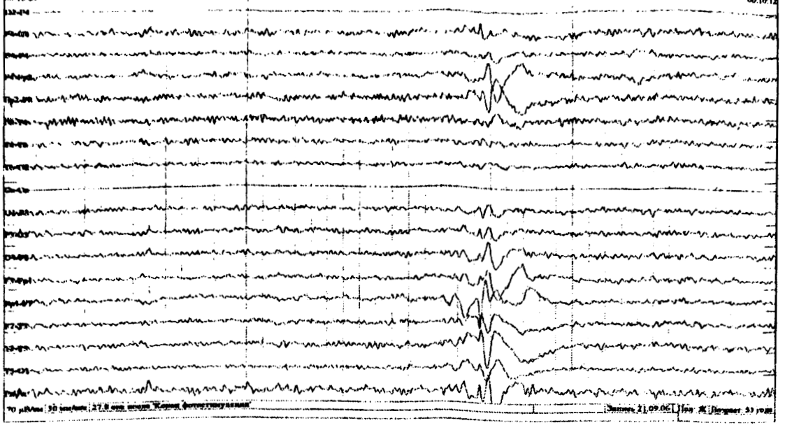 Лобная эпилепсия. Билатерально синхронные вспышки в ритма на ЭЭГ. Билатерально-синхронные вспышки что это. Эпилептиформная активность на ЭЭГ. Эпилептиформная активность на ЭЭГ фото.