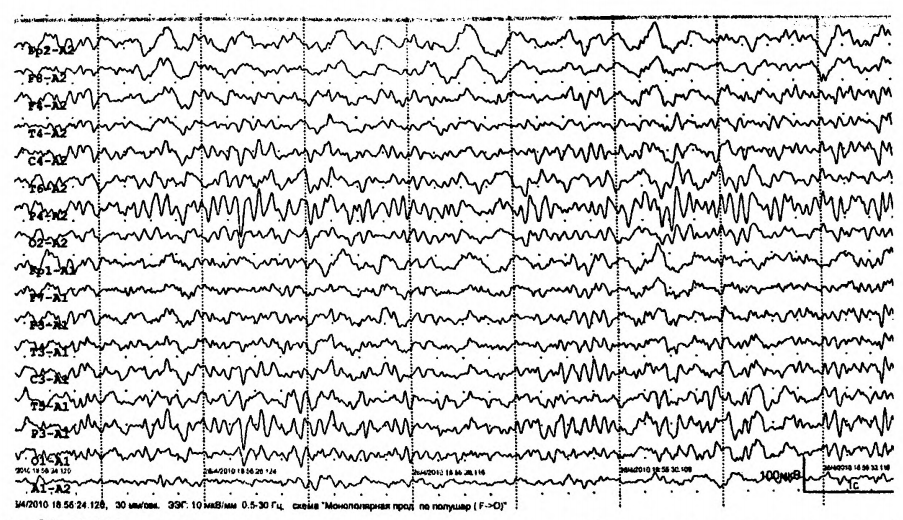 Потенциал ээг. Полифазные потенциалы на ЭЭГ. Высокоамплитудные Дельта волны на ЭЭГ. Fast activity на ЭЭГ. ЭЭГ при звуковой стимуляции.