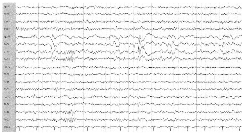 Диффузные эпилептиформные. Эпилептиформная активность на ЭЭГ. Комплексы Спайк-волна на ЭЭГ. Полипик на ЭЭГ. Интериктальная эпилептиформная активность.