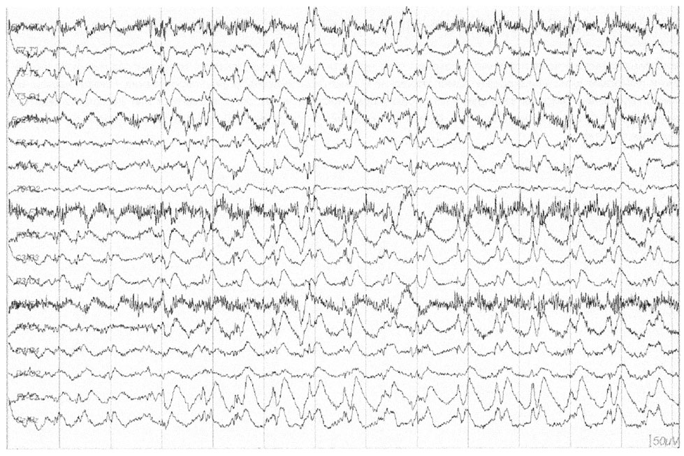 Диффузные эпилептиформные. Эпилептиформная активность на ЭЭГ. Пик медленная волна на ЭЭГ что это. Острая медленная волна. Разряд эпилептиформной активности.