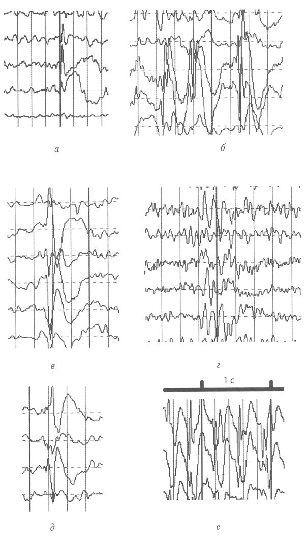 Индекс эпилептиформной активности. Пик полипик волна на ЭЭГ. Гипсаритмия на ЭЭГ. Эпи волна на ЭЭГ. Эпи паттерны на ЭЭГ.
